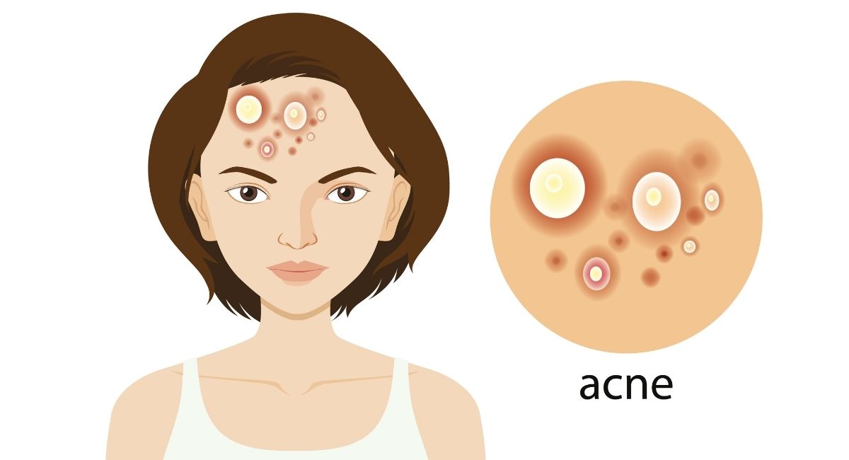 Los 10 mejores alimentos para evitar el acné y los puntos negros