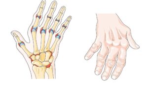 Hábitos saludables para la artritis reumatoide