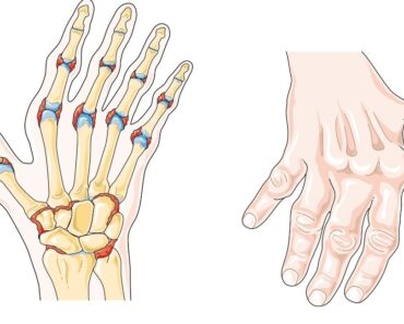 Hábitos saludables para la artritis reumatoide