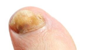 Cómo tratar los hongos en las uñas de los pies