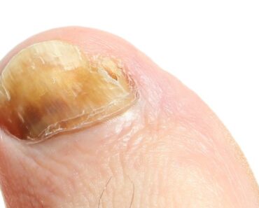 Cómo tratar los hongos en las uñas de los pies