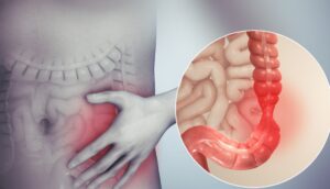 Causas y factores de riesgo del síndrome del intestino irritable (SII)