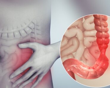 Causas y factores de riesgo del síndrome del intestino irritable (SII)
