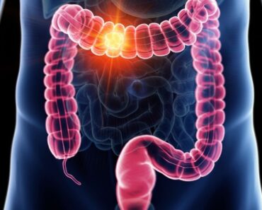 Todo sobre el cáncer de colon: causas, síntomas y tratamiento
