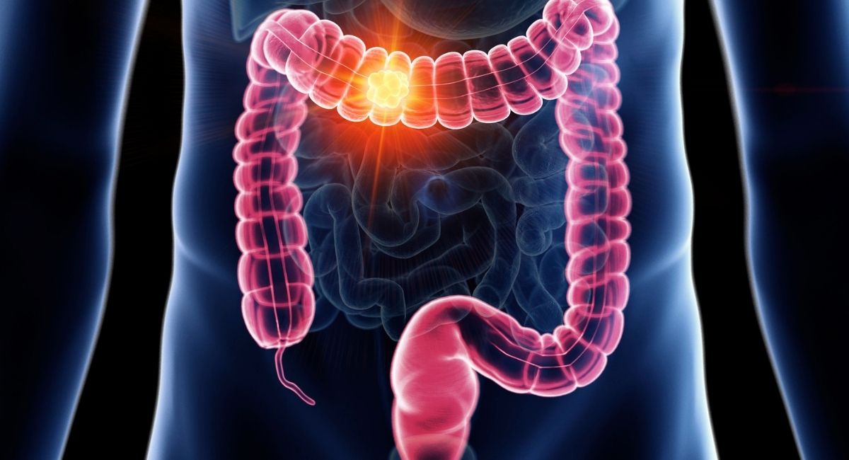 Todo sobre el cáncer de colon: causas, síntomas y tratamiento