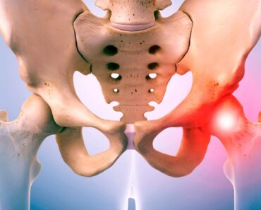 dolor 8 Razones del dolor de cadera (y tratamientos)de cadera