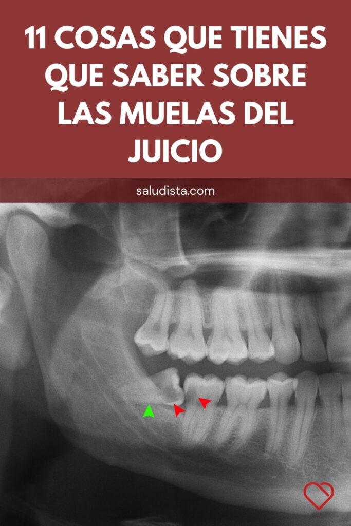 11 Cosas que tienes que saber sobre las muelas del juicio