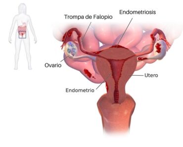 7 Síntomas de endometriosis (causas y tratamiento)