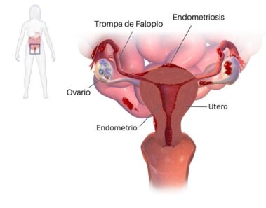 7 Síntomas de endometriosis (causas y tratamiento)
