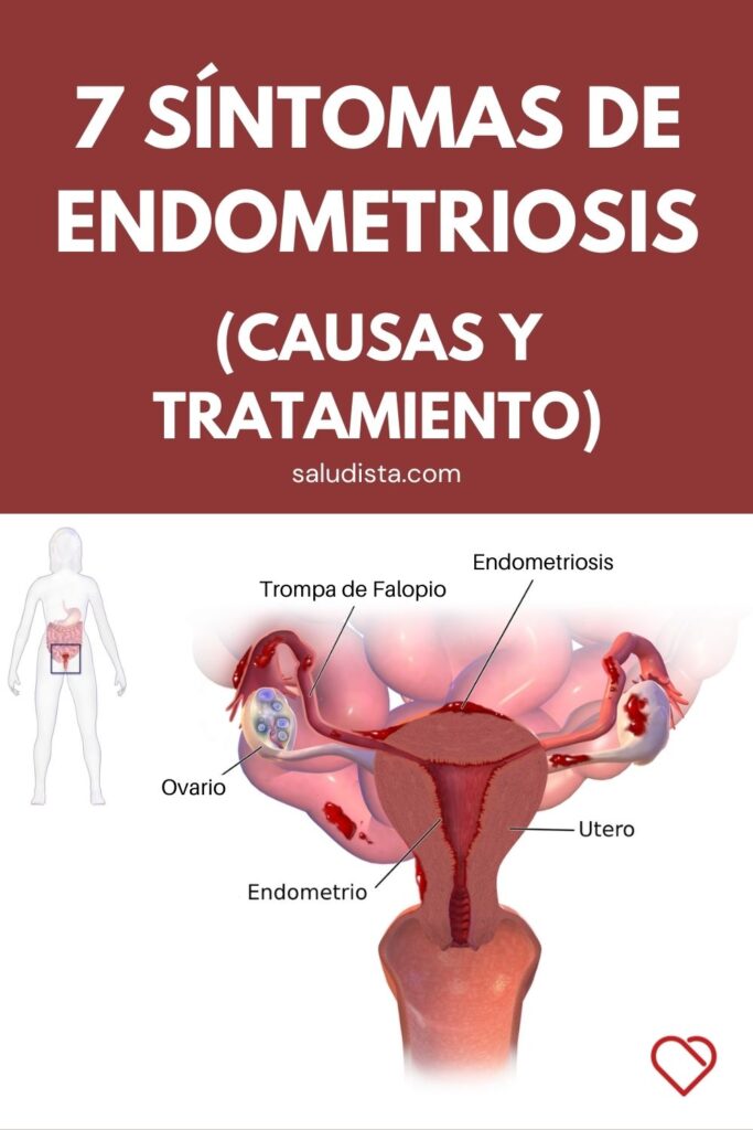 7 Síntomas De Endometriosis Causas Y Tratamiento 0261