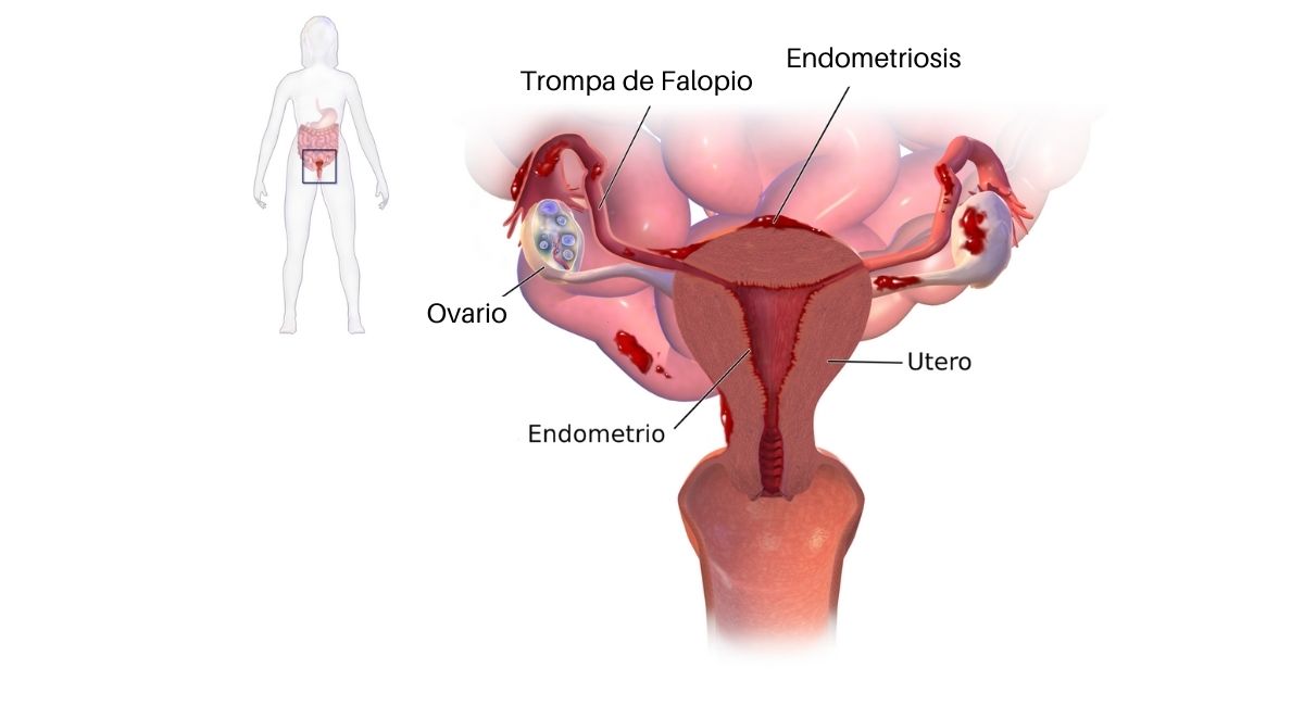 7 Síntomas de endometriosis (causas y tratamiento)