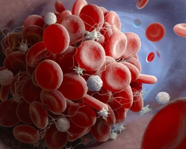 Síntomas de los coágulos de sangre: Cómo saber si tienes uno
