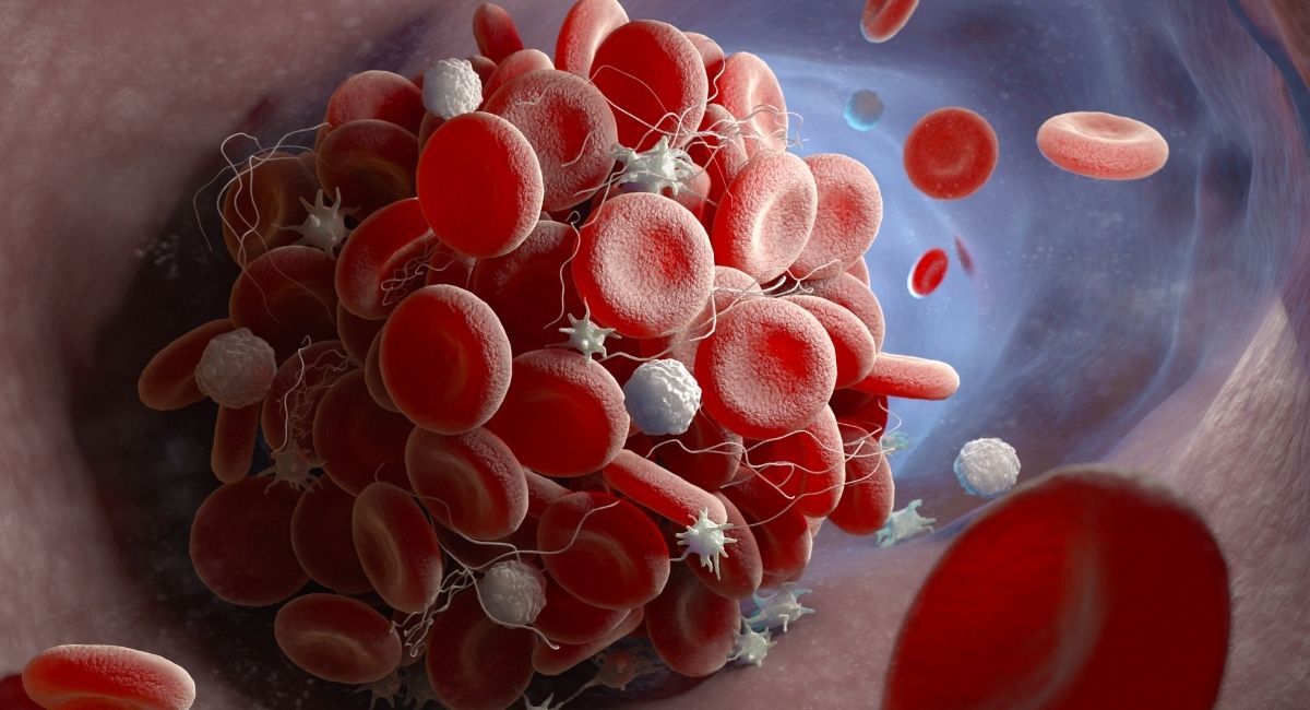 Síntomas de los coágulos de sangre: Cómo saber si tienes uno