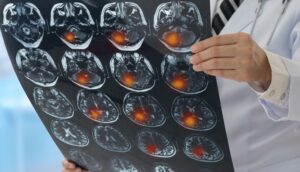 Un estudio afirma que COVID podría provocar una pérdida cerebral a largo plazo