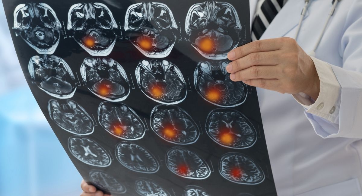 Un estudio afirma que COVID podría provocar una pérdida cerebral a largo plazo